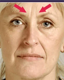 Бръчки между веждите